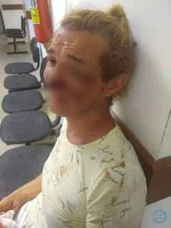 Mulher trans é espancada pelo suposto amante e tem parte do nariz arrancado