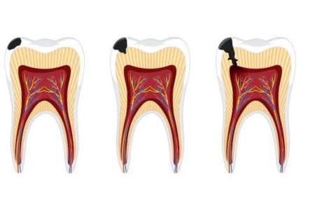 Exercício físico e ômega-3 ajudam a reduz gravidade de infecção dental