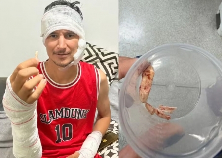 Peão guarda como amuleto garra de onça que ficou cravada em perna durante ataque no Pantanal