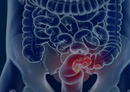 Pacientes com câncer colorretal são diagnosticados em estágio avançado