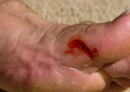 Nova Andradina registra primeiro óbito por tétano em 2026